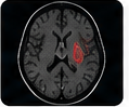 MRI 脑肿瘤分割示意图